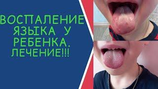 ВОСПАЛЕНИЕ ЯЗЫКА У РЕБЕНКА!!!ГЕОГРАФИЧЕСКИЙ ЯЗЫК !!!ПОЛНОЕ ИЗЛЕЧЕНИЕ!!!!НАРОДНЫЕ РЕЦЕПТЫ!!!!